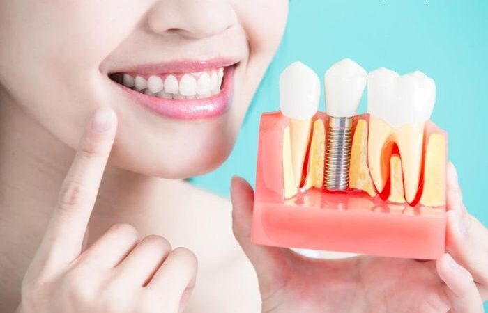 Implants That Last Why Dental Implants Are the Gold Standard in Tooth Replacement